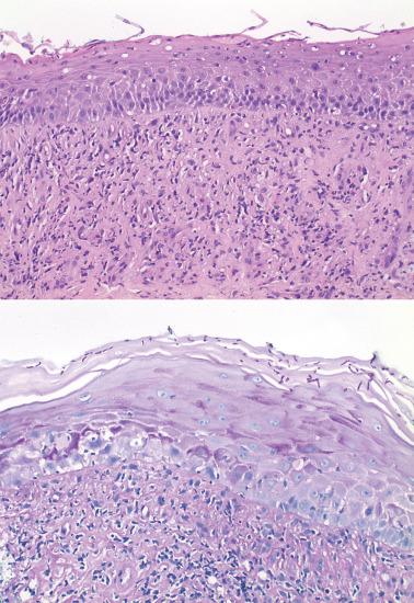 Fig. 1.11, Fungal (candidal) vulvitis, H&E (top) and PAS (bottom) stains.