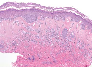 Fig. 1.13, Lichen sclerosus. The typical homogenized collagen beneath the epithelium is conspicuous and underlying it is prominent chronic inflammation in a somewhat band-like manner.