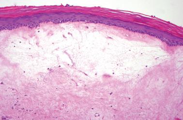 Fig. 1.14, Lichen sclerosus. In contrast to Fig. 1.13 , this example shows prominent edema within the collagenized dermis.