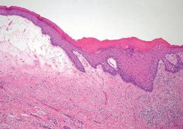 Fig. 1.15, Lichen sclerosus with adjacent differentiated vulvar intraepithelial neoplasia. Lichen sclerosus (left) and typical ‘glassy’ cytoplasm with basal atypia of differentiated VIN (right).