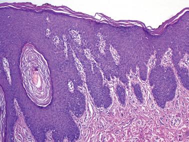 Fig. 1.16, Squamous cell hyperplasia, NOS. The hyperplastic squamous epithelium has no specific features.