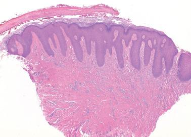 Fig. 1.17, Lichen simplex chronicus.