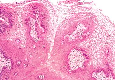 Fig. 1.18, Squamous papillomatosis. The squamous cells have clear cytoplasm due to the presence of glycogen, but are not koilocytotic.