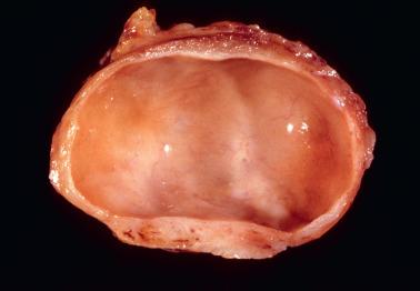 Fig. 1.20, Bartholin's duct cyst.