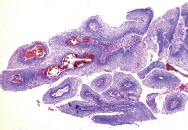 Fig. 1.2, Condyloma acuminatum. Low-power view shows typical papillary configuration.