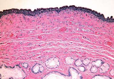 Fig. 1.21, Bartholin's duct cyst. The squamous lining of the cyst (top) and normal Bartholin's gland tissue (bottom) are seen.