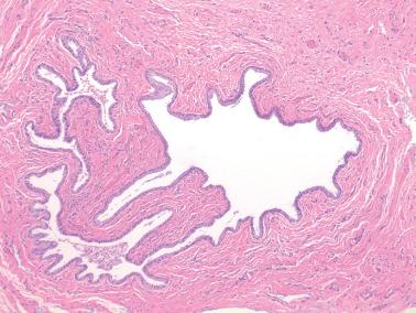 Fig. 1.22, Mucinous vestibular cyst.