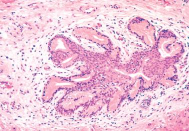 Fig. 1.23, Vulvar vestibulitis. A minor vestibular gland shows squamous metaplasia and chronic inflammatory cells in the surrounding stroma.