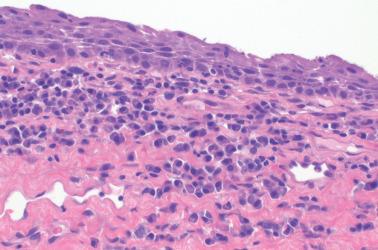 Fig. 1.24, Plasma cell vulvitis.