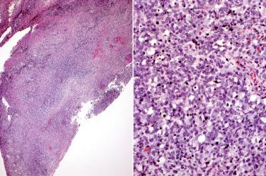 Fig. 1.26, Florid reactive lymphoid hyperplasia. Vulvar biopsy from a patient with malaise shows ulceration and marked inflammatory infiltrate (left). High-power view of the infiltrate shows large lymphoid cells, scattered immunoblasts with prominent nucleoli, and apoptosis (right). This patient was subsequently documented to have infectious mononucleosis.