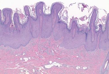 Fig. 1.3, Condyloma acuminatum. Multiple papillary projections with hyperkeratosis range from rounded to spired.