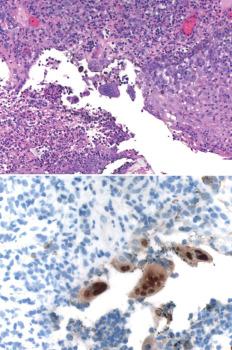 Fig. 1.8, Herpetic infection. There is marked ulceration with an inflammatory exudate and two centrally located multinucleated cells with ground glass nuclei (top). Immunohistochemical staining for HSV is positive in the multinucleated cells (bottom).