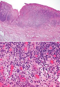Fig. 1.9, CMV infection. Excision for carcinoma in situ (top, left) shows marked ulceration with prominent inflammation (top, right)). Enlarged endothelial cells with intranuclear inclusion which were positive with a CMV immunostain are seen on high power (bottom).