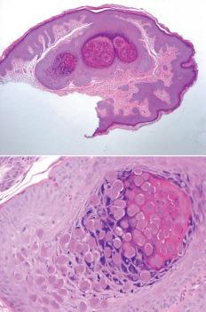 Fig. 1.10, Molluscum contagiosum. Typical low-power view showing well-delineated aggregates of eosinophilic material (top). The characteristic intracytoplasmic viral inclusions which displace the nucleus are seen on high power (bottom).