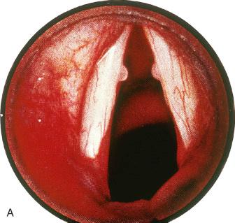 Fig. 15-1, Vocal cord polyps.