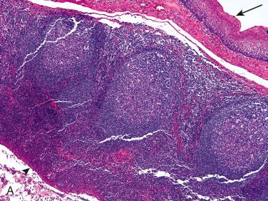 Fig. 15-11, Tonsillar-type cyst.