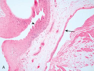 Fig. 15-12, Laryngeal cyst.