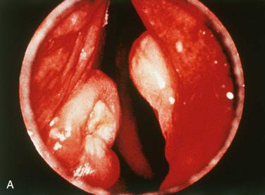 Fig. 15-14, Laryngeal contact ulcers.