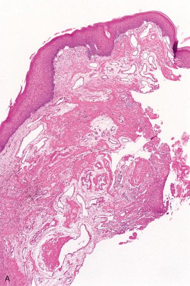 Fig. 15-2, Histology of vocal cord polyps.