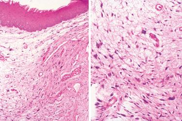 Fig. 15-4, Atypical stromal cells.