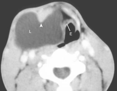 Fig. 15-5, Large laryngocele.