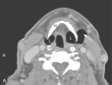 Fig. 15-6, Bilateral air-filled laryngoceles (axial CT).