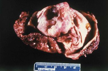 Fig. 15-8, Excised laryngocele.