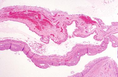 Fig. 15-9, Histology of laryngocele.