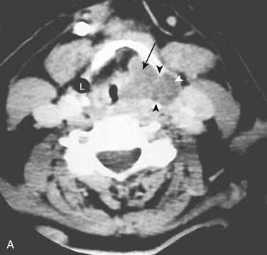 Fig. 15-10, Axial CT of a laryngocele (saccular cyst).