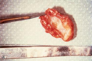 Fig. 12-3, Second branchial cleft cyst.