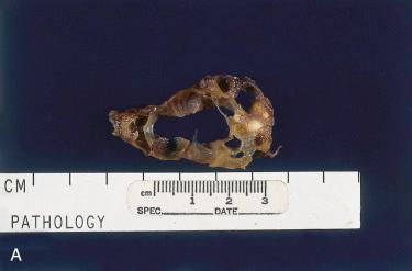 Fig. 12-5, Cervical thymic cyst.