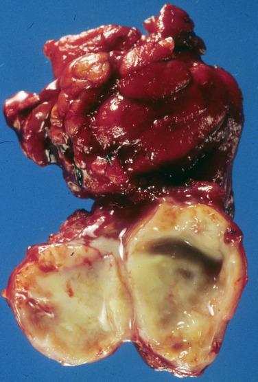 FIGURE 20.1, There is a thick, fibrous wall of connective tissue surrounding this cyst, which is filled with tan-yellow material.