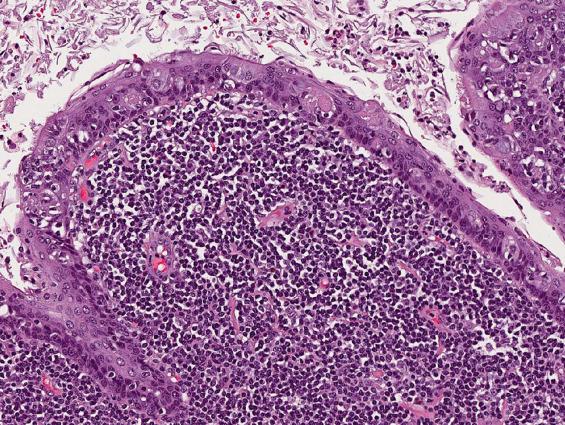 FIGURE 20.3, Keratinaceous debris is frequently present; the cyst may be stratified ciliated columnar epithelium or squamous epithelium.