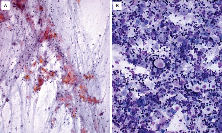 FIGURE 20.4, Keratinaceous debris with inflammatory cells is diagnostic of a branchial cleft cyst in fine needle aspiration smears as long as there are no atypia in the epithelial component. ( A ) Alcohol-fixed, Papanicolaou-stained smear. ( B ) Air-dried, Diff-Quik–stained smear.