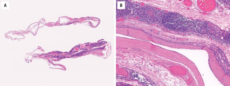 FIGURE 20.5, ( A , B ). The wall of this thymic cyst contains lymphoid aggregates, fat, and Hassall corpuscles; this appearance may sometimes mimic that of a branchial cleft cyst.