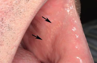 FIGURE 7.1, Clinical photograph of asymptomatic, multiple, small, yellow papules on the buccal mucosa ( arrows ) in this example of Fordyce granules.