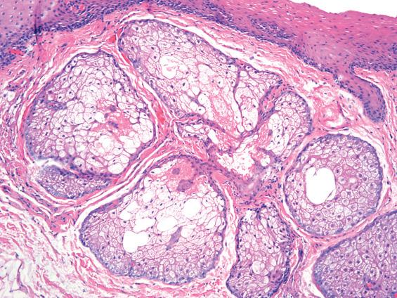 FIGURE 7.2, Multiple sebaceous glands in the superficial lamina propria.