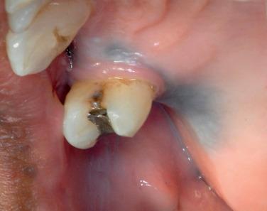 FIGURE 7.3, Clinical photograph of a blue-gray pigment present on the maxillary alveolar ridge. The pigmented area is flat with no ulceration or induration, and is asymptomatic.