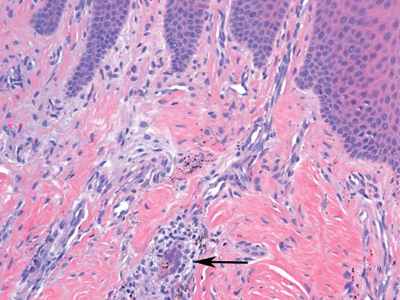 FIGURE 7.4, Black pigmented material is seen scattered in the lamina propria along collagen bundles and around blood vessels. The overlying epithelium is normal, and scant inflammatory cells are present. Although unusual, foreign body giant cell reactions can occur ( arrow ).