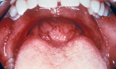 FIGURE 7.5, Clinical photograph of a lingual thyroid presenting as a midline nodular mass at the base of the tongue. The surface is smooth and hyperemic.