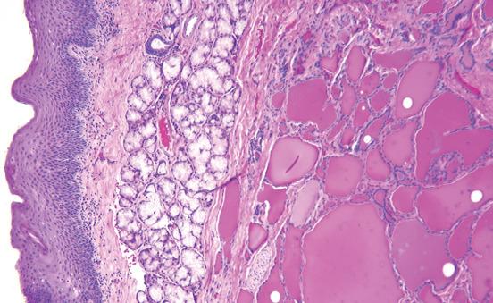 FIGURE 7.6, Normal stratified squamous epithelium overlying a unencapsulated collection of thyroid follicles. Note the minor mucoserous glands adjacent to the thyroid follicles.