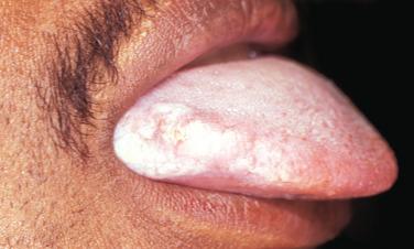 FIGURE 7.7, HIV-positive patient with a white patch on the lateral border of the tongue exhibiting a corrugated appearance in this example of oral hairy leukoplakia.