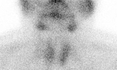 FIGURE 26.1, A delayed 99m Tc sestamibi image demonstrates uneven, increased uptake in all glands, consistent with hyperplasia.