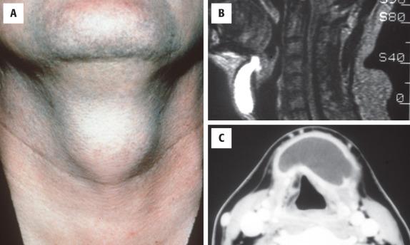 FIGURE 23.1, A, Neck mass in the midline, encompassing the hyoid bone, which moves with swallowing. B, Magnetic resonance image showing a bright signal of the fluid-filled thyroglossal duct cyst as it extends from the foramen cecum. C, Computed tomography scan showing a large fluid-filled cyst anterior to the larynx. Note a slight “shift” to the left of midline.