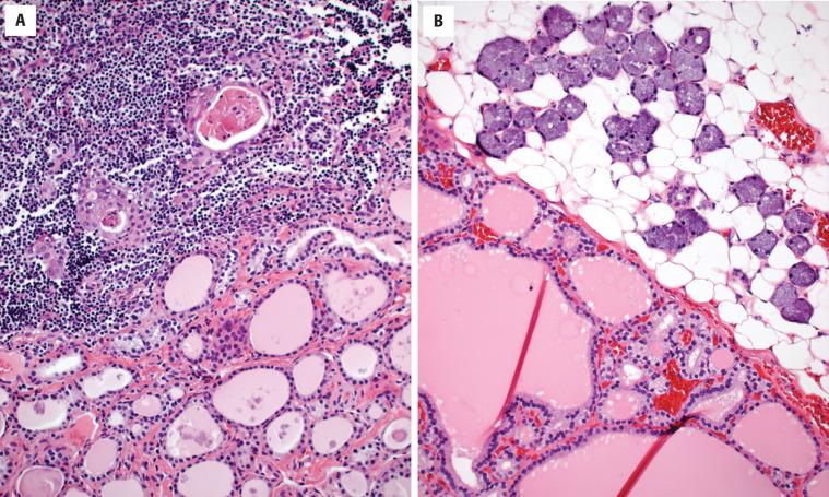 FIGURE 23.11, Thymic tissue ( A ) is noted in direct continuity with the thyroid gland. Salivary gland tissue B, is noted adjacent to unremarkable thyroid parenchyma. These are normal tissue elements without any tissue reaction.