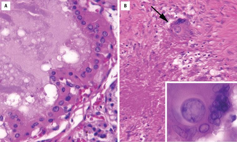 FIGURE 23.12, A, Thyroid follicular epithelium is oncocytic with organisms identified within the colloid. B, Coccidioidomycosis organisms (arrow and inset) are identified in a background of necrosis in this case of acute thyroiditis.