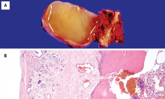 FIGURE 23.2, A, This thyroglossal duct cyst is from a Sistrunk procedure and includes the cyst, the tract of the thyroglossal duct, and the midsection of the hyoid bone. B, Thyroid parenchyma is noted at the left side, while a portion of bone and marrow is noted immediately adjacent.