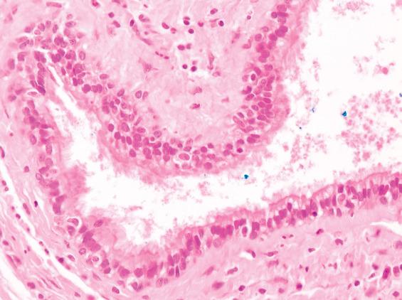 FIGURE 23.3, Thyroglossal duct cyst. The cyst is lined in this case by respiratory epithelium and is surrounded by fibrous tissue.