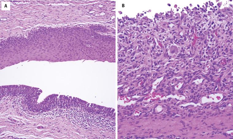 FIGURE 23.4, A, Cyst lining is both squamous epithelium ( upper ) and respiratory type ( lower ) in this thyroglossal duct cyst. B, Infection may cause denudation of the epithelial lining, which is replaced by granulation tissue.