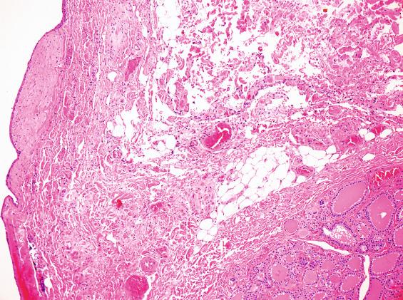 FIGURE 23.5, Thyroid parenchyma is seen in the cyst wall ( lower right ) of this thyroglossal duct cyst ( left ).